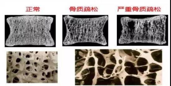 杭州骨科专家：可乐和咖啡可能会偷走你的身高